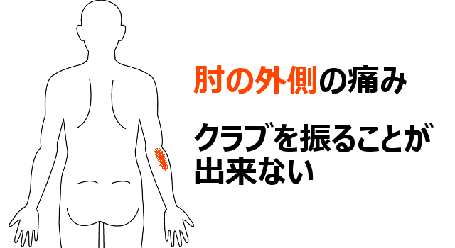 肘の外側の痛み