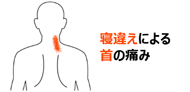 寝違えによる首の痛み | 東大阪市八戸ノ里 | あきた鍼灸整骨院