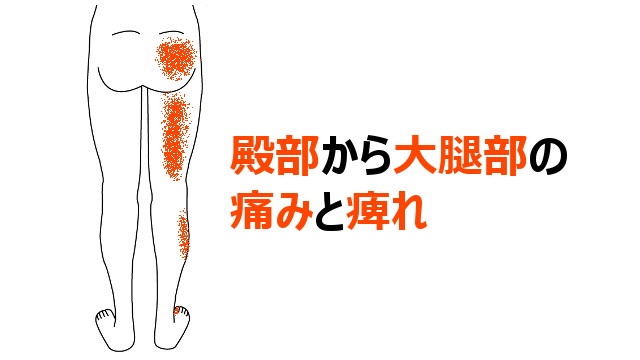 殿部から大腿部の後面の痛みと痺れ