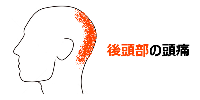 後頭部の頭痛
